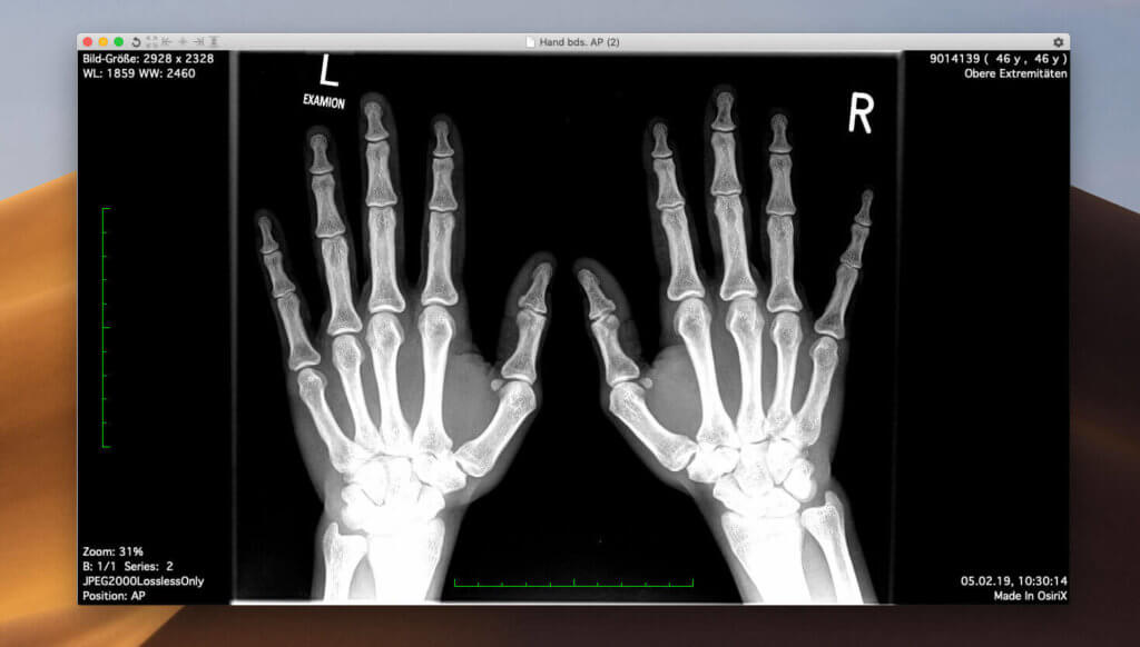 Der DICOM Viewer Osirix Lite ist die kostenlose Variante der OsiriX-Software, die für Patienten verwendet werden kann. Das Betrachten der MRT- oder Röntgenaufnahmen ist damit kein Problem – sowohl am Mac als auch am Windows-PC.